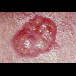 Profile picture of Skin cancer