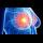 Profile picture of Triple-negative breast cancer
