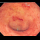 Profile picture of ulcerative colitis